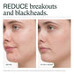 Before and after comparison of a person's face with text indicating reduction of breakouts and blackheads.